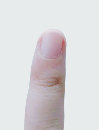 指甲出現(xiàn)一條黑線 別不當(dāng)回事！可能是癌變