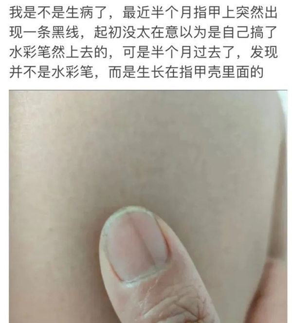 指甲出現(xiàn)一條黑線 別不當(dāng)回事！可能是癌變