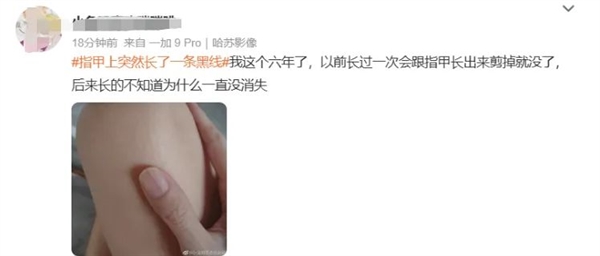 指甲出現(xiàn)一條黑線 別不當(dāng)回事！可能是癌變