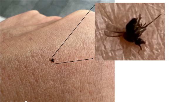 身上突然不明原因癢一下、又紅又腫：不是蚊子咬的