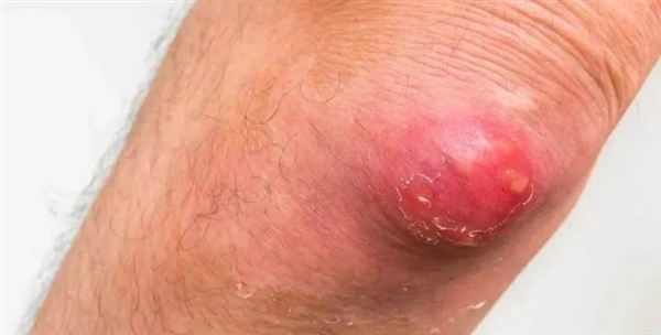 一種“紅包”又痛又腫：硬擠還很危險