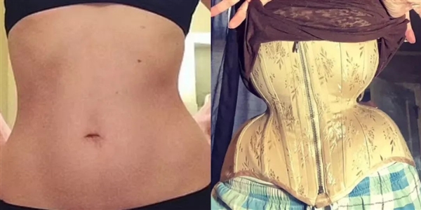 腰圍39厘米仍不滿足 美國女子每天穿16小時塑身衣 無視健康風(fēng)險