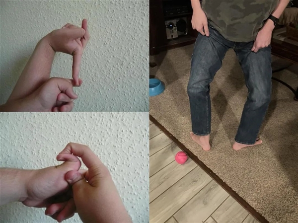 英國男子皮膚Q彈破紀錄：脖子皮膚一拉可當口罩戴