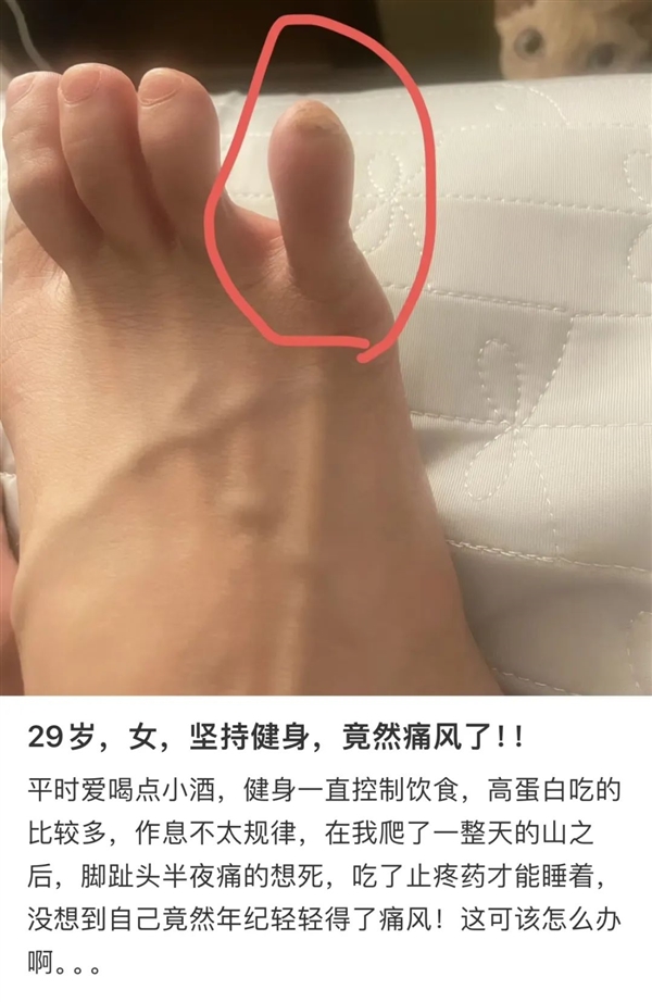 痛風(fēng) 正在席卷中國(guó)年輕人......