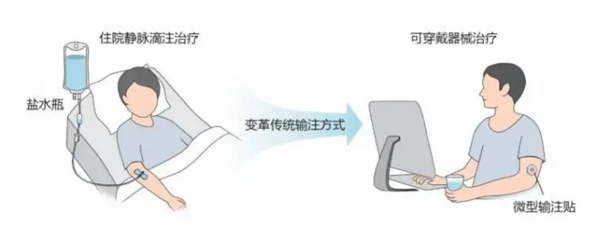 浙大團(tuán)隊(duì)發(fā)明貼敷式輸注貼：實(shí)現(xiàn)無(wú)痛“無(wú)線”掛鹽水