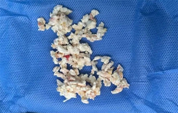 每天兩碗！六旬老伯愛喝骨頭湯：膝蓋長滿痛風(fēng)石