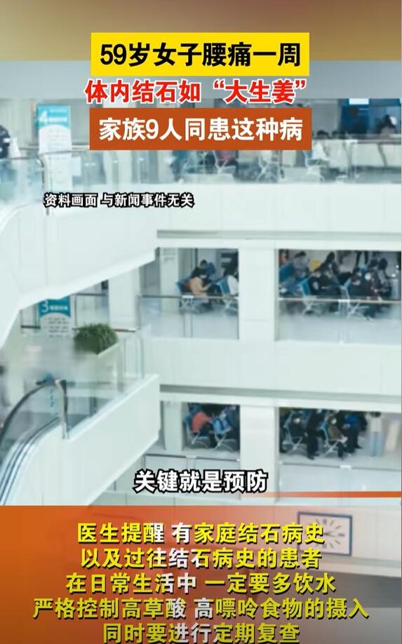 59歲女子腰痛一周體內(nèi)長(zhǎng)“生姜”：家族9人無(wú)一幸免