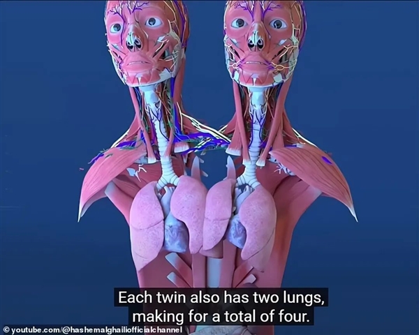 美國雙頭連體人懷孕！腰部以下身體共享 誰才是孩他媽