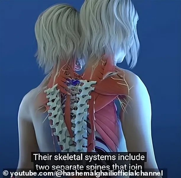 美國雙頭連體人懷孕！腰部以下身體共享 誰才是孩他媽