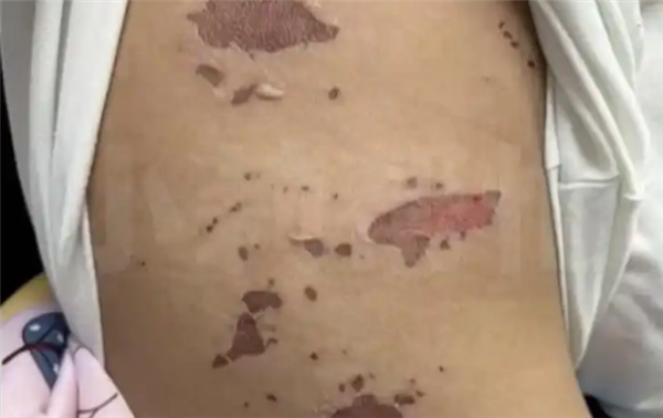 3歲男童吃火鍋燙嘴后竟全身潰爛 醫(yī)生：有傳染性